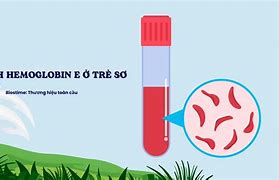 Bệnh Hemoglobin E Ở Trẻ Sơ Sinh